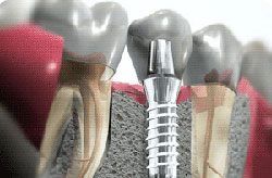 implant_g